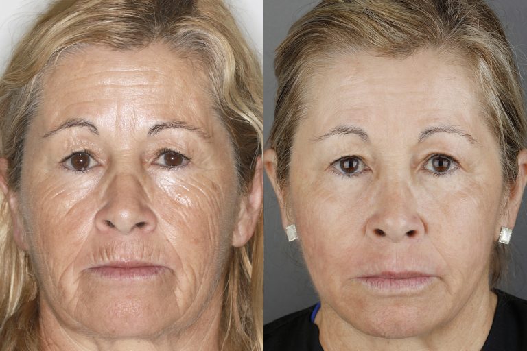 Rejuvenescimento Facial - Dental Care Clinic